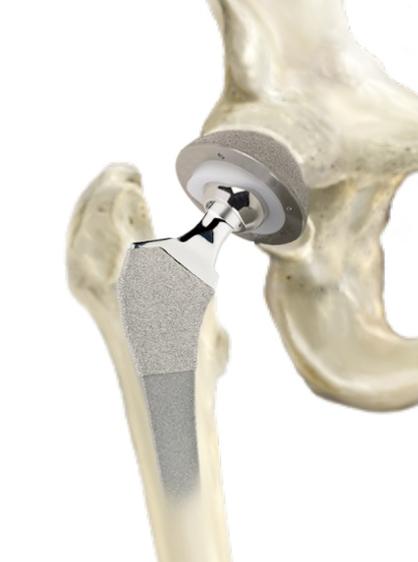 SuperPath Total Hip Replacement