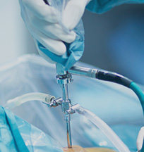 Arthroscopic Surgery